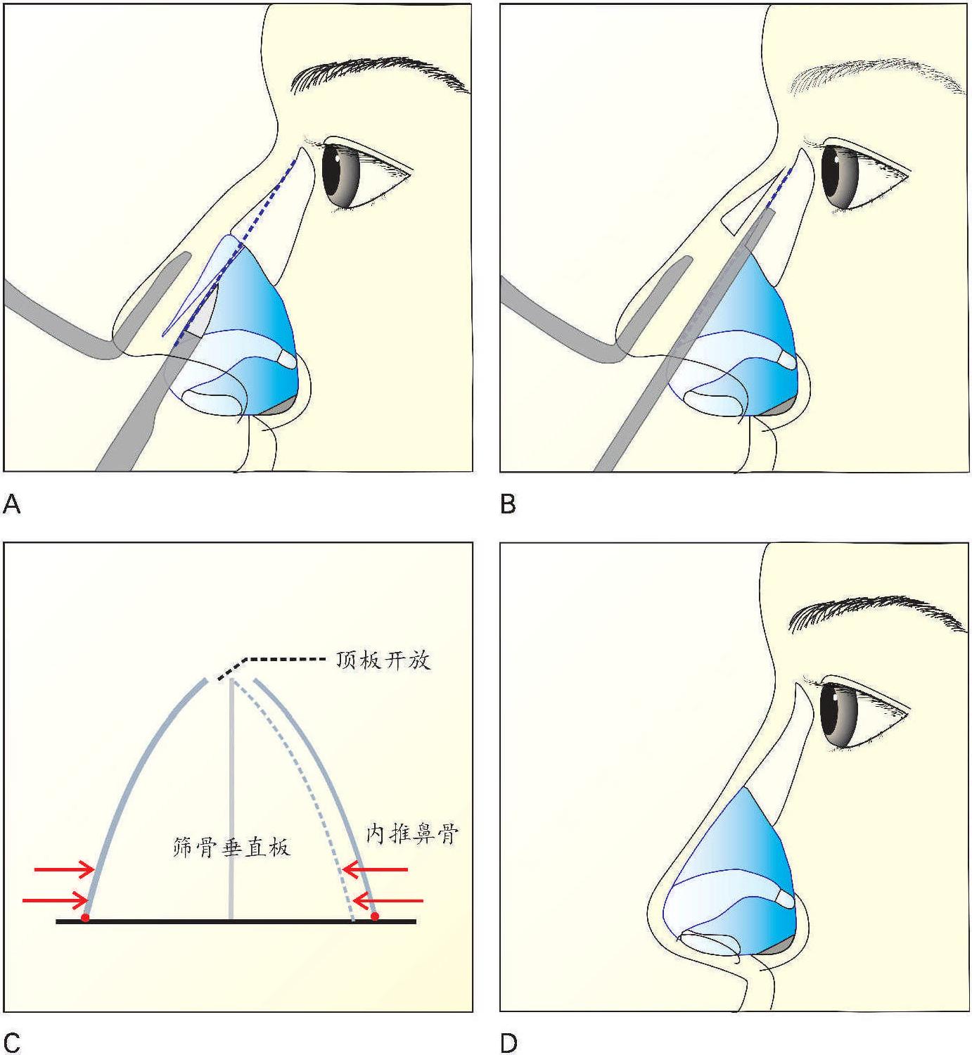 二 手術(shù)方法